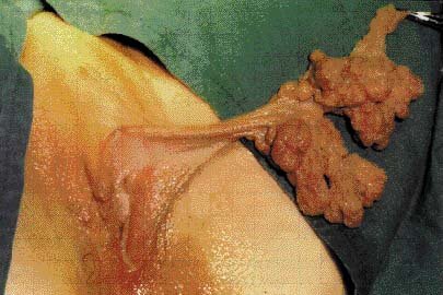 Vaginal Fibroma