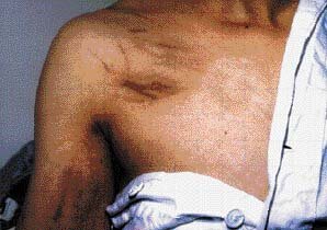 Flagellate Hyperpigmentation