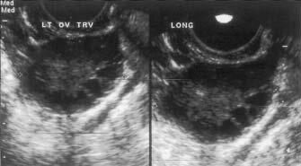 Ultrasound
