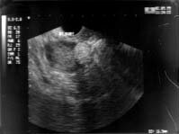 Enlarged ovaries and each containing a small hyperechoric mass