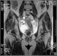 Magnetic resonance imaging of the pelvis