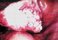 Diagnostic laparoscopy