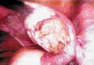 Diagnostic laparoscopy