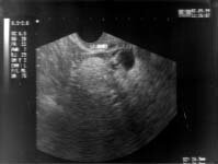 Enlarged ovaries and each containing a small hyperechoric mass
