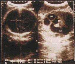 Ultrasound